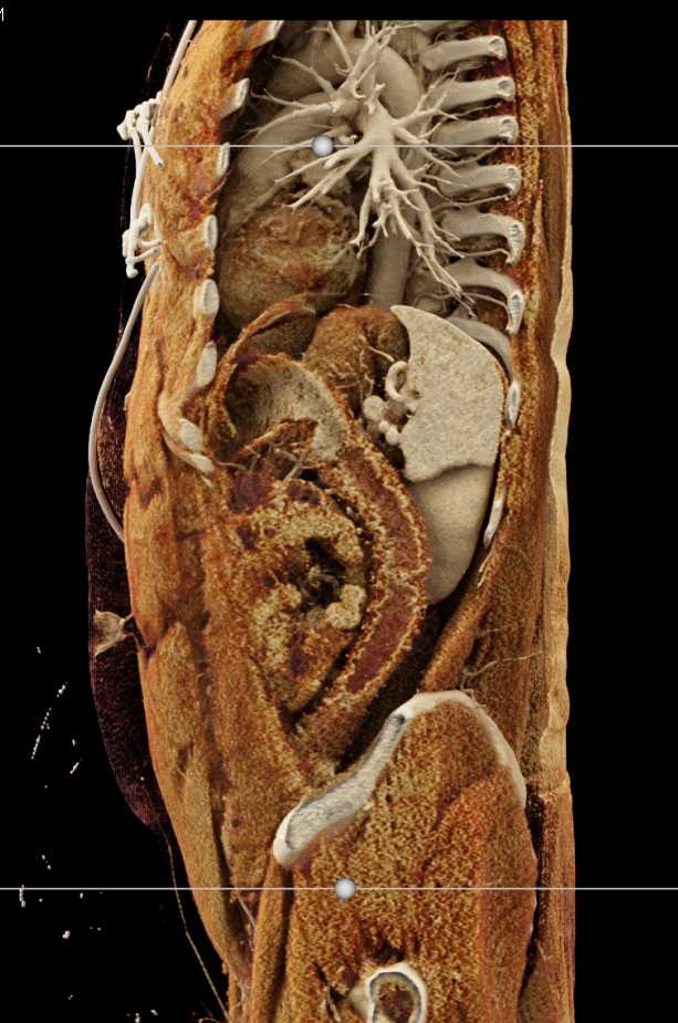 Ulcerative Colitis with Cinematic Rendering - CTisus CT Scan