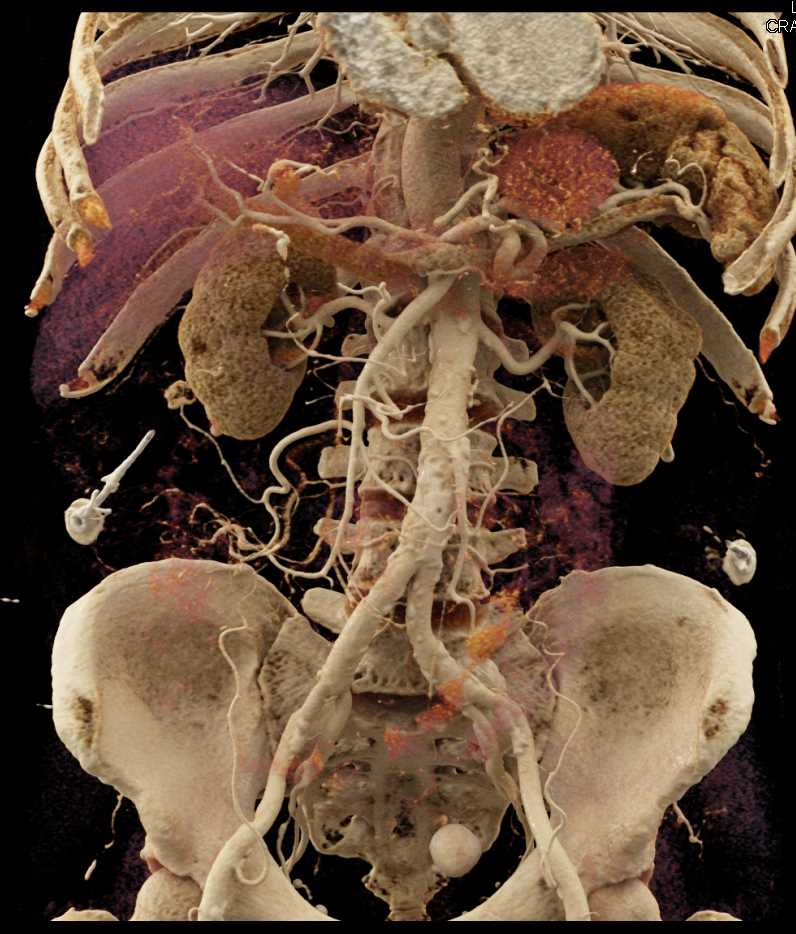 Diverticular Disease - CTisus CT Scan