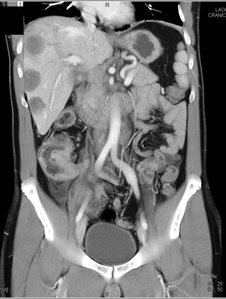 Cecal Cancer with Liver Metastases - CTisus CT Scan