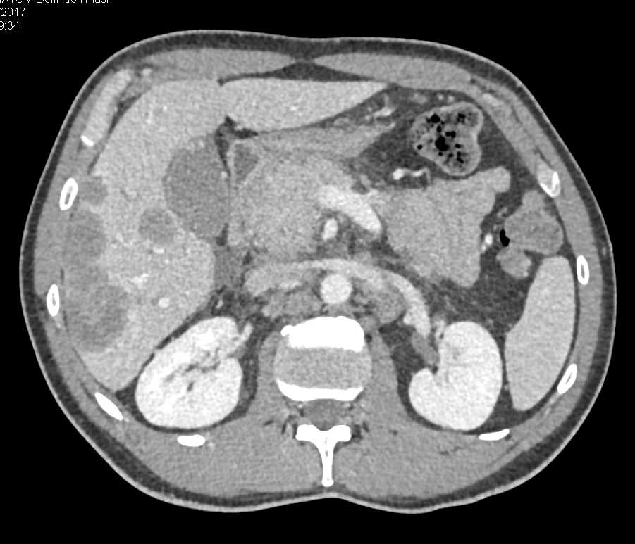 Cecal Cancer with Liver Metastases - CTisus CT Scan