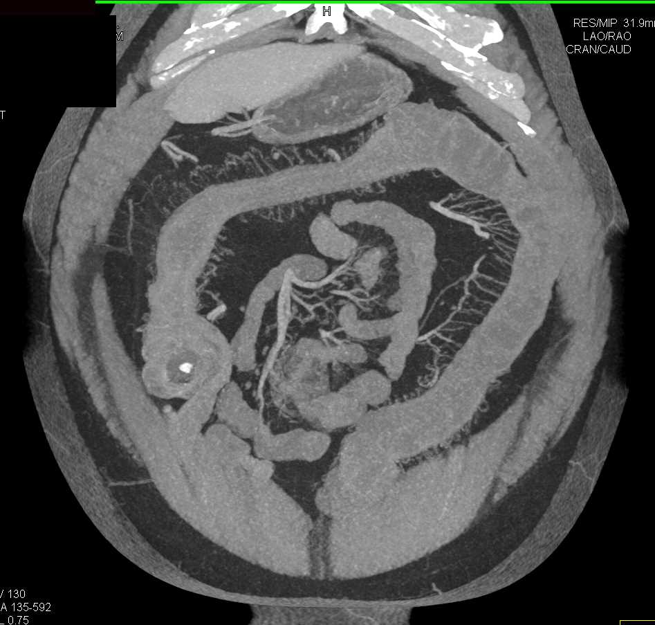 Ulcerative Colitis - CTisus CT Scan