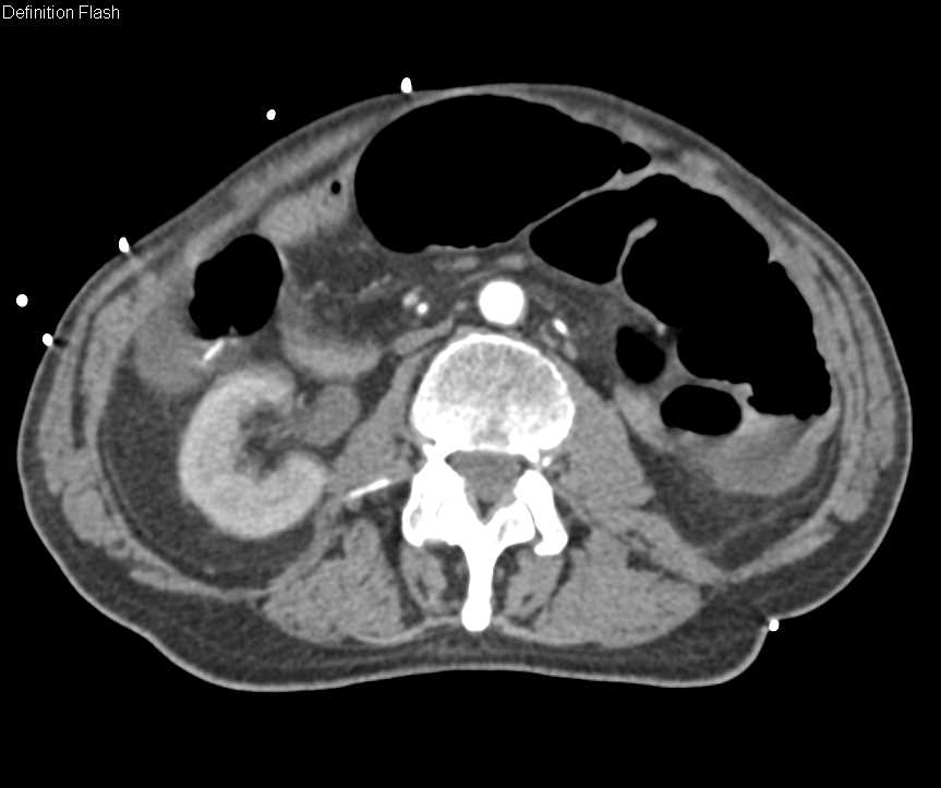 Active Rectal Bleed Best seen on the Venous Phase Images - CTisus CT Scan