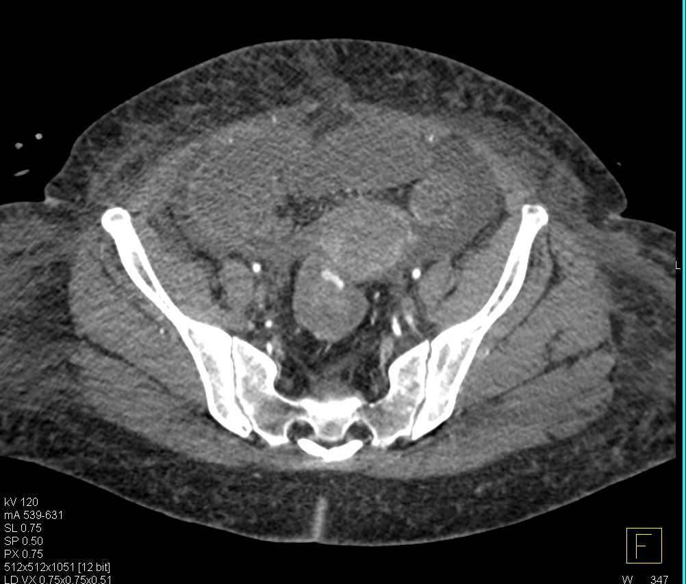 Active Bleed in the Rectum - CTisus CT Scan