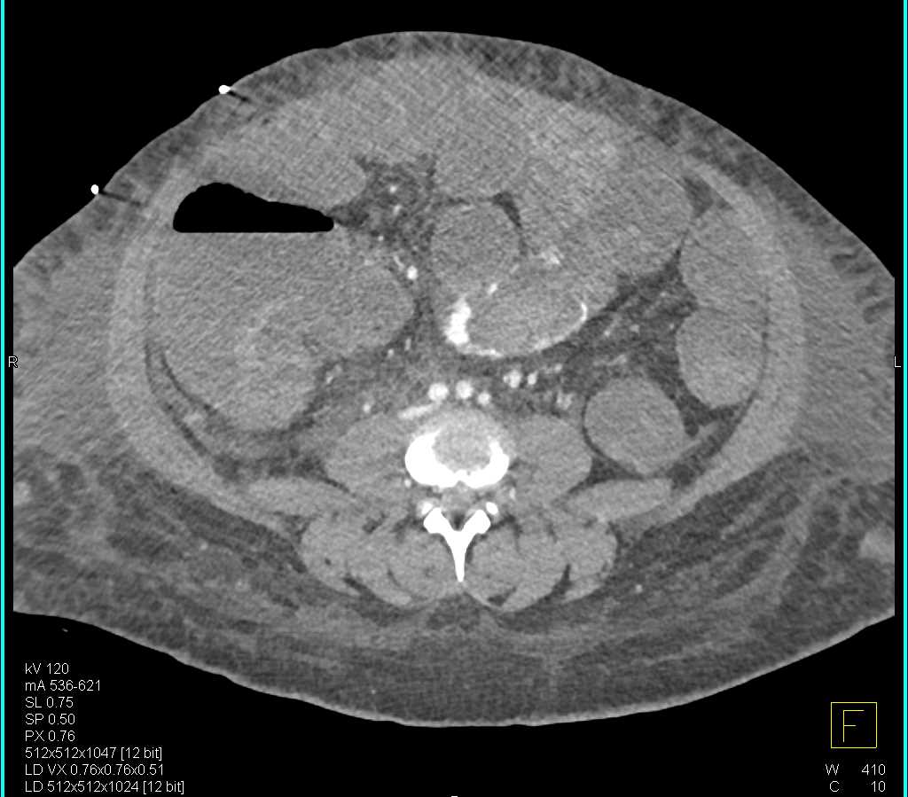 Active Bleed in the Sigmoid Colon - CTisus CT Scan