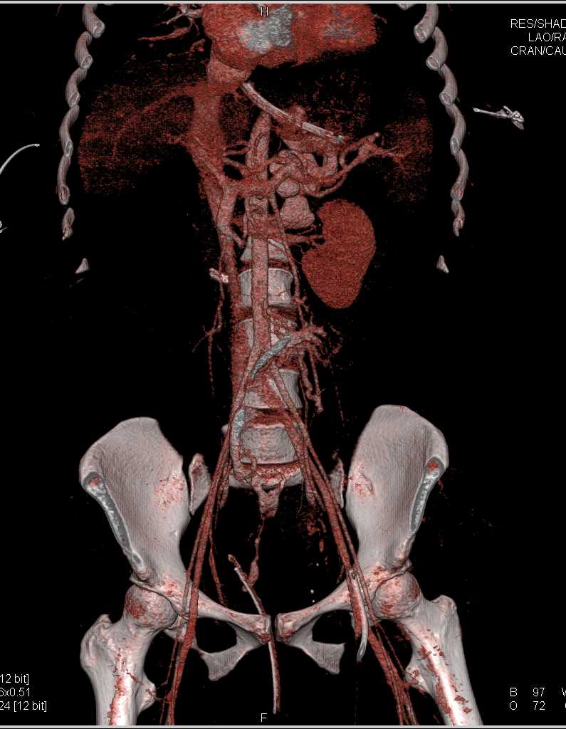 Active Bleed in the Sigmoid Colon - CTisus CT Scan