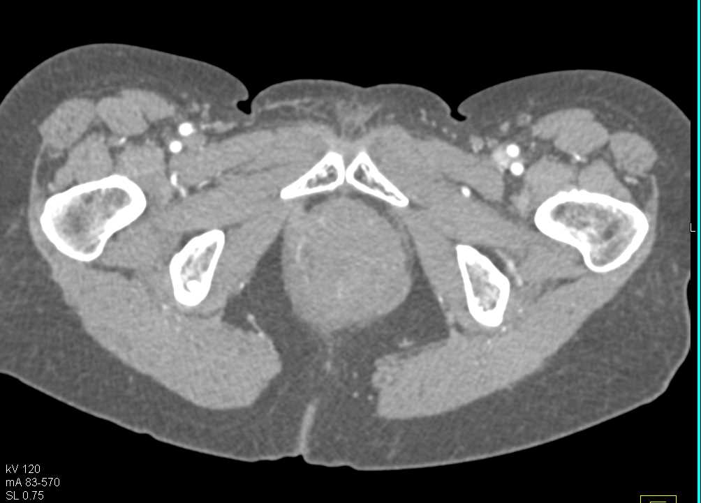 Rectal Prolapse and Rectal Cancer - CTisus CT Scan