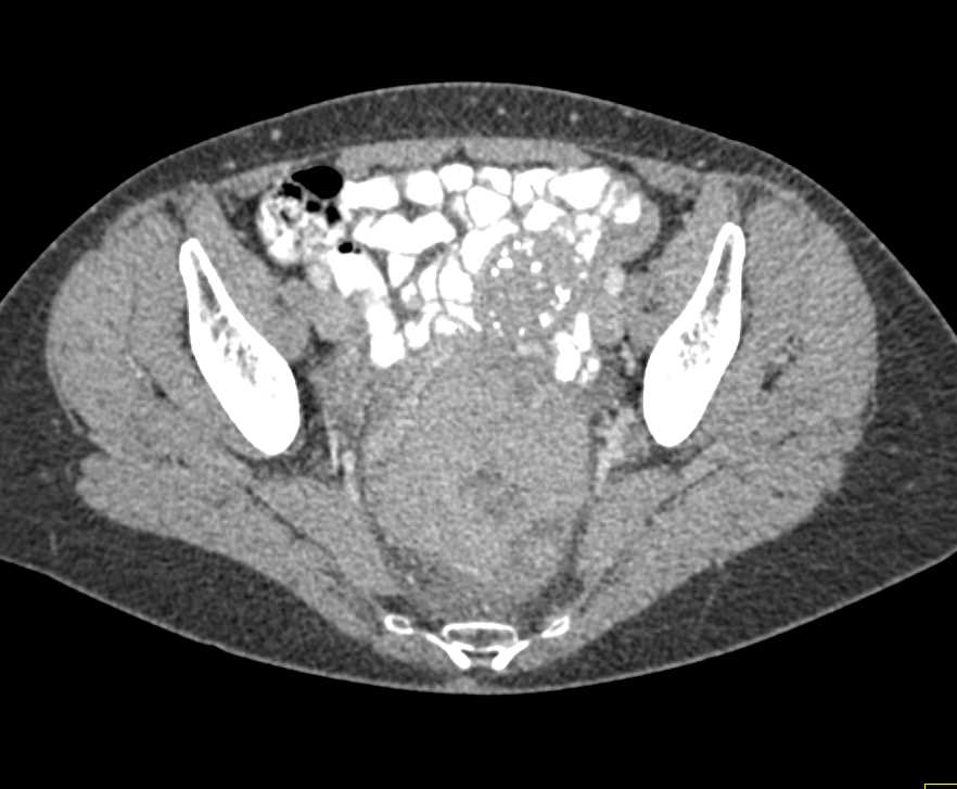 Rectal GIST Tumor - CTisus CT Scan