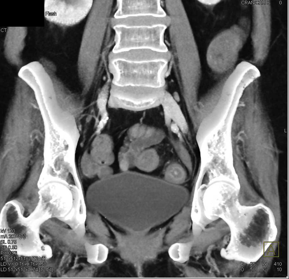 Ulcerative Colitis  - CTisus CT Scan