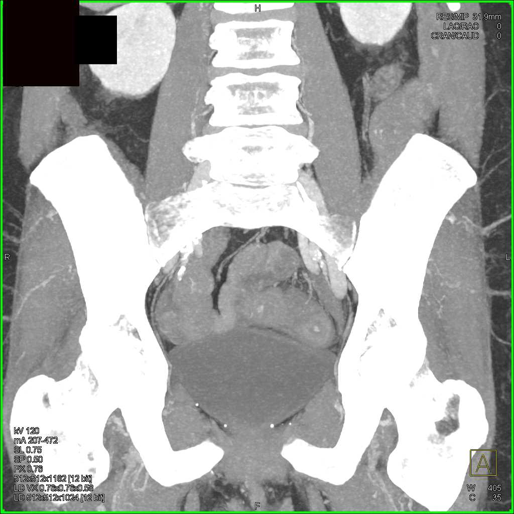 Ulcerative Colitis  - CTisus CT Scan