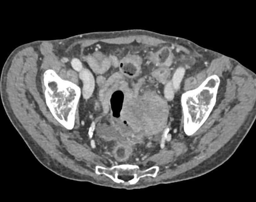 Colon Cancer with Adenopathy - CTisus CT Scan