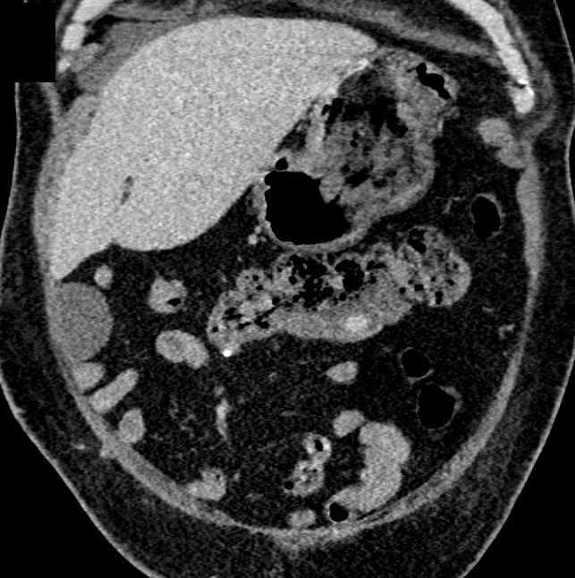 Diverticulum Transverse Colon - CTisus CT Scan