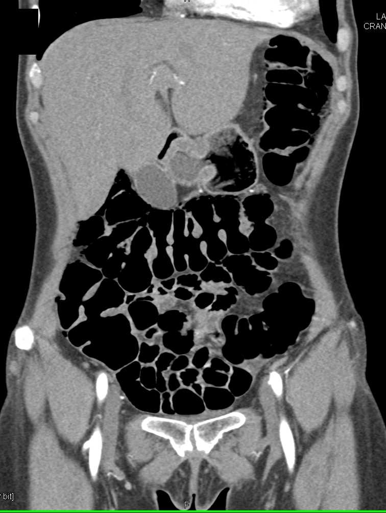 Pneumatosis Colon - CTisus CT Scan