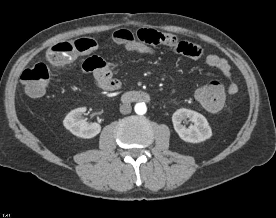 Gastrointestinal (GI) Bleed Near Hepatic Flexure - CTisus CT Scan