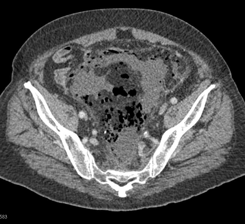 Abscess with Perforation Left Lower Quadrant - CTisus CT Scan