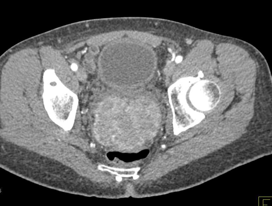 Rectal GIST Tumor - CTisus CT Scan