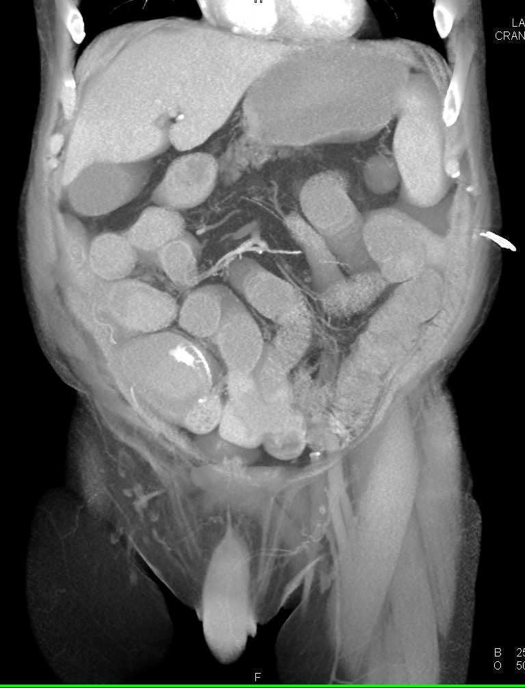 Active Bleed Right Colon - CTisus CT Scan