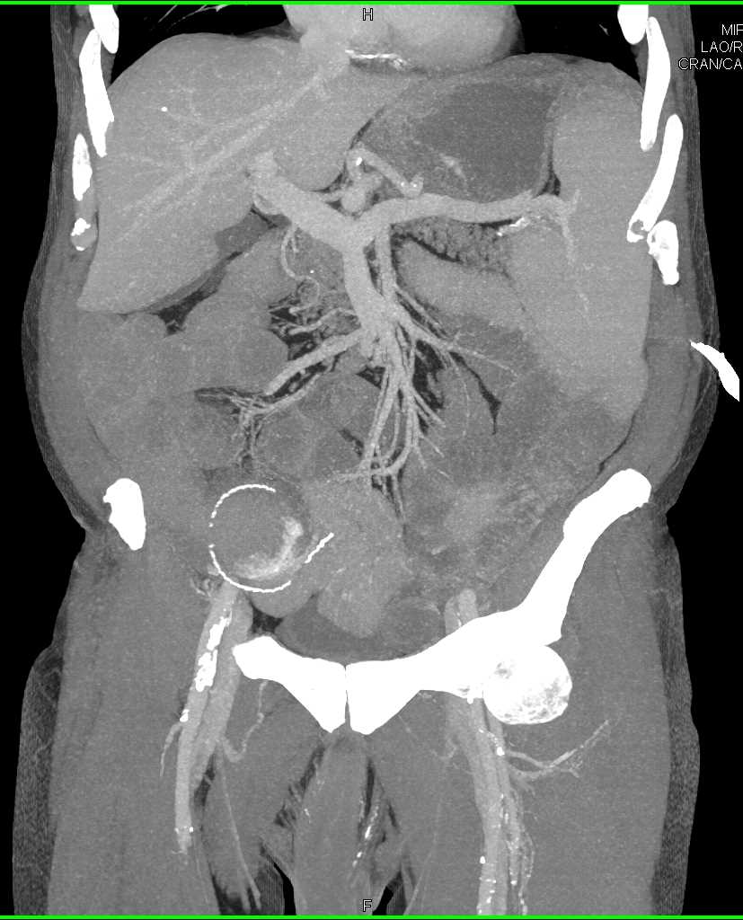 Active Bleed in the Right Colon - CTisus CT Scan