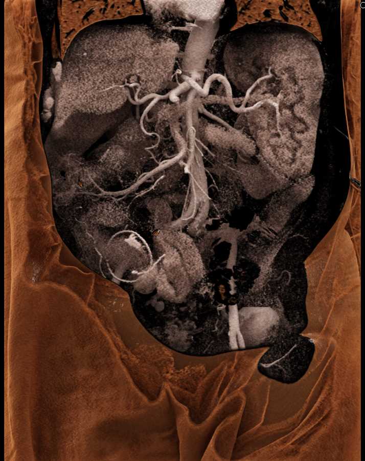 Active Bleed in the Right Colon - CTisus CT Scan