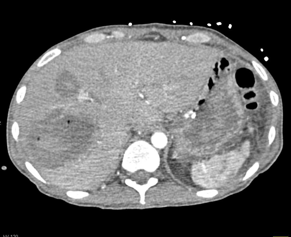 Active Bleed in Transverse Colon Near Splenic Flexure - CTisus CT Scan