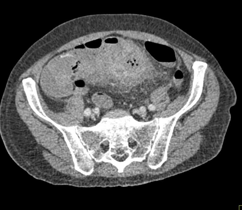 Appendicitis with Appendeceal Abscess - CTisus CT Scan