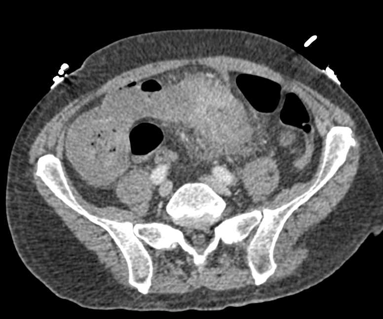 Appendeceal Abscess - CTisus CT Scan