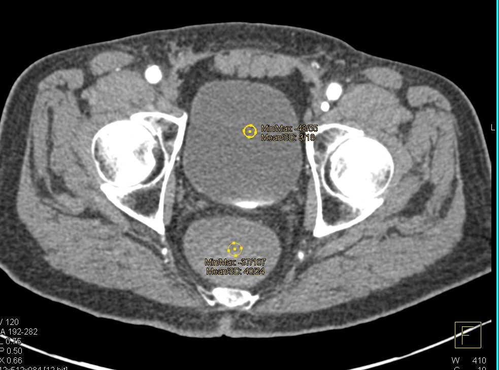 Active Gastrointestinal (GI) Bleed in Right Colon - CTisus CT Scan