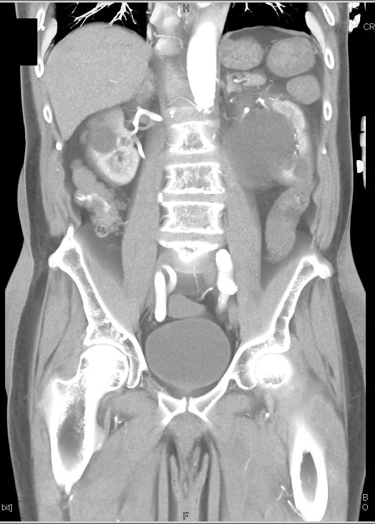 Active GI Bleed in Right Colon - CTisus CT Scan