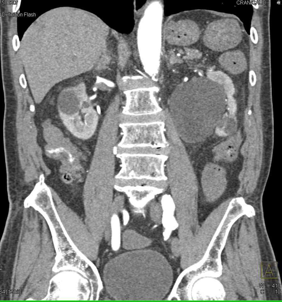 Active Gastrointestinal (GI) Bleed in Right Colon - CTisus CT Scan