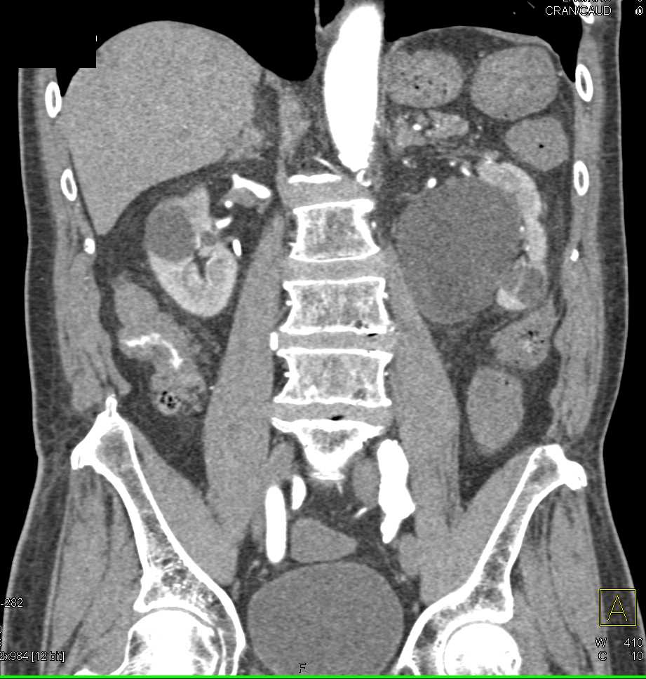 Active GI Bleed in Right Colon - CTisus CT Scan
