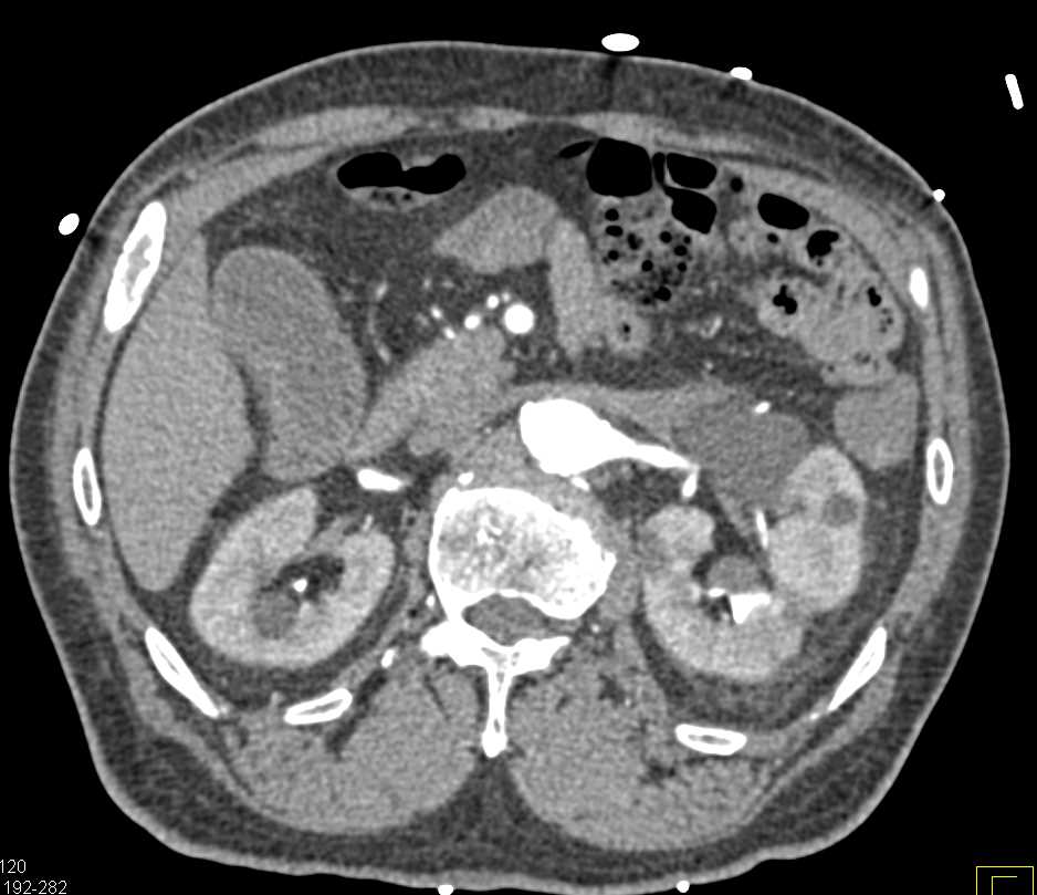 Diverticulitis Right Colon - CTisus CT Scan