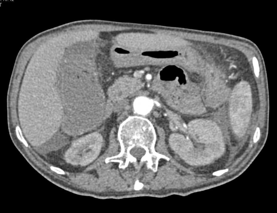 Ulcerative Colitis with Stricture Near Splenic Flexure - CTisus CT Scan