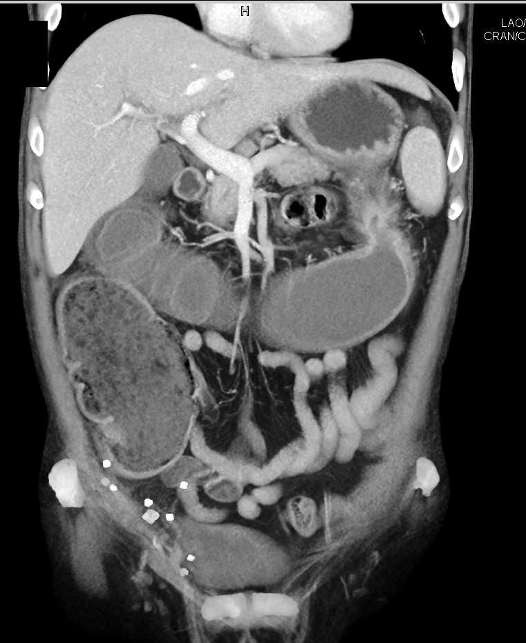 Ulcerative Colitis with Stricture Near Splenic Flexure - CTisus CT Scan
