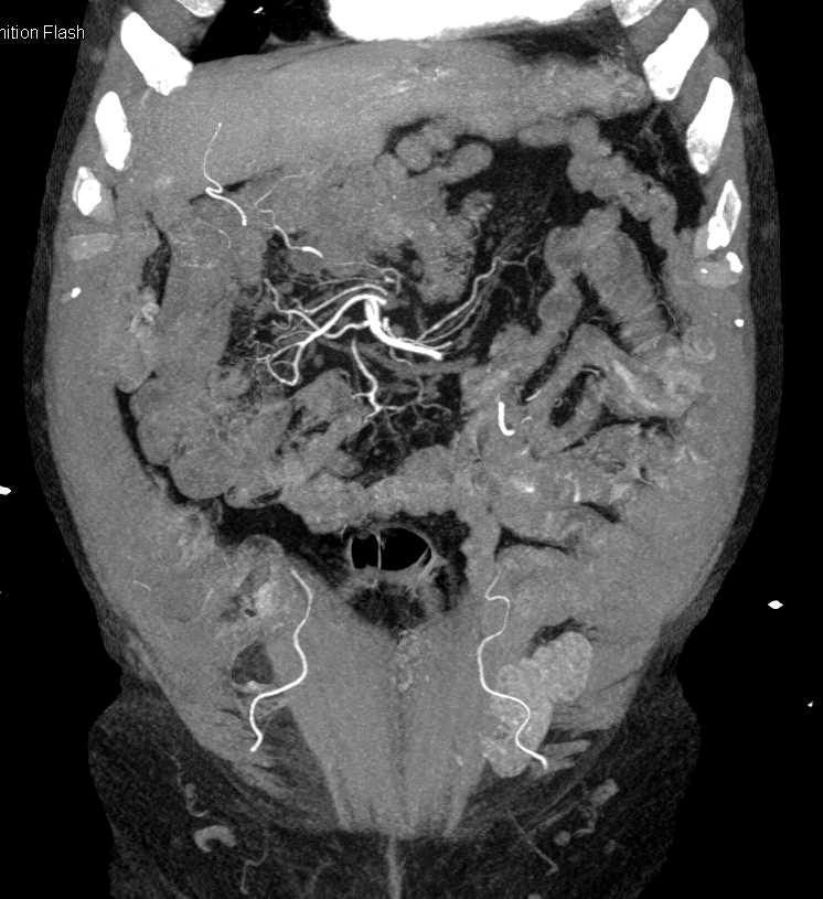 Diverticular Bleed Descending Colon - CTisus CT Scan