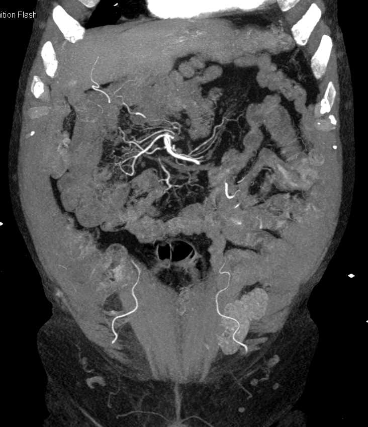 Diverticular Bleed Descending Colon - CTisus CT Scan