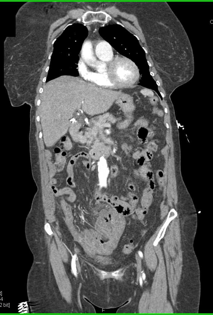 Ulcerating Sigmoid Colon Cancer - CTisus CT Scan