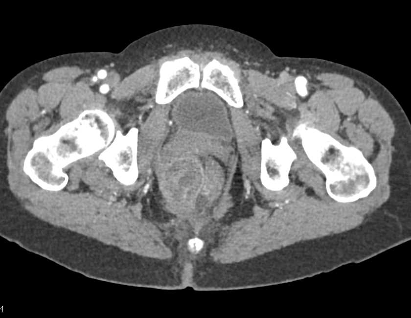 Perirectal Abscess - CTisus CT Scan