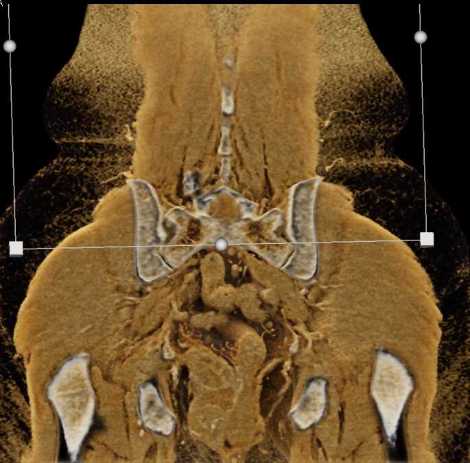 Perirectal Abscess - CTisus CT Scan