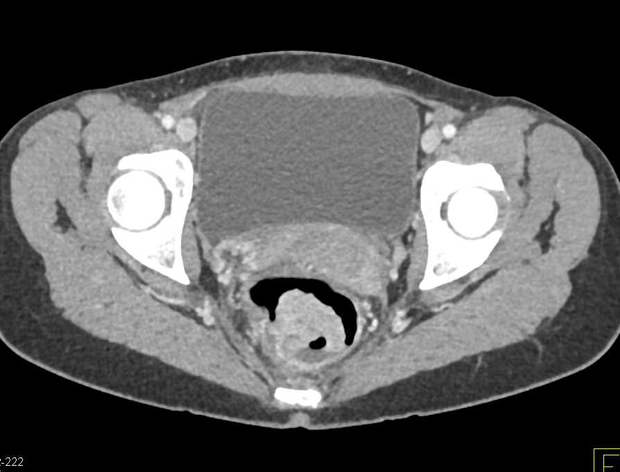 Ulcerating Rectal Cancer - CTisus CT Scan