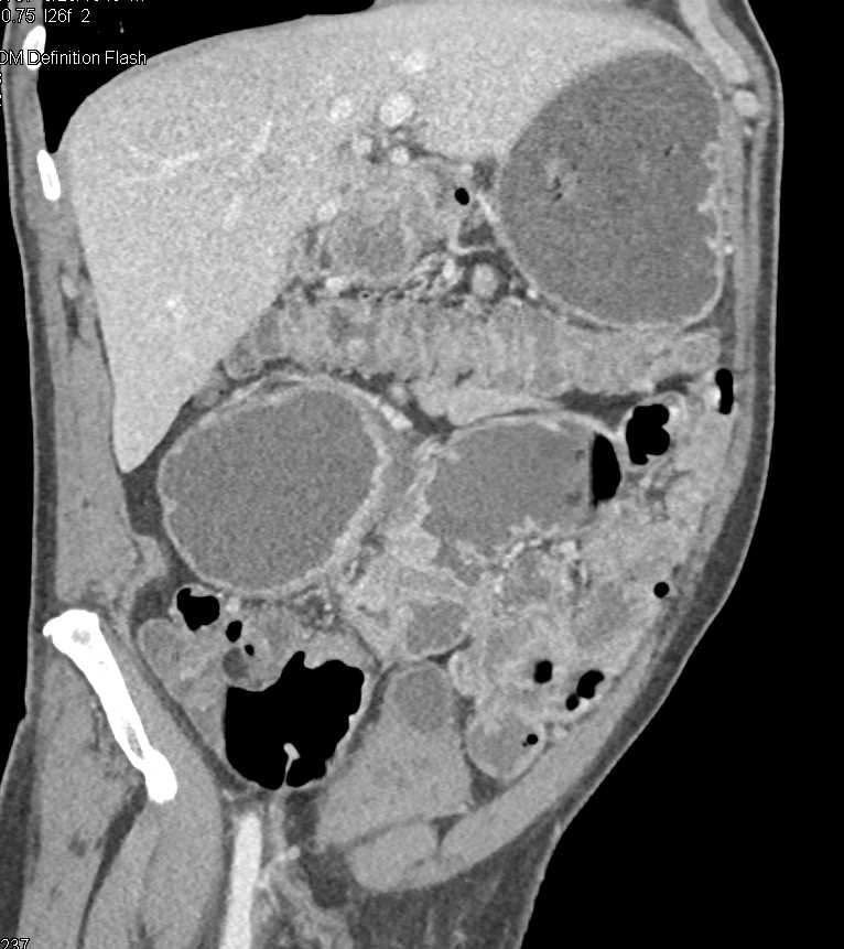 Colon Cancer - Colon Case Studies - CTisus CT Scanning