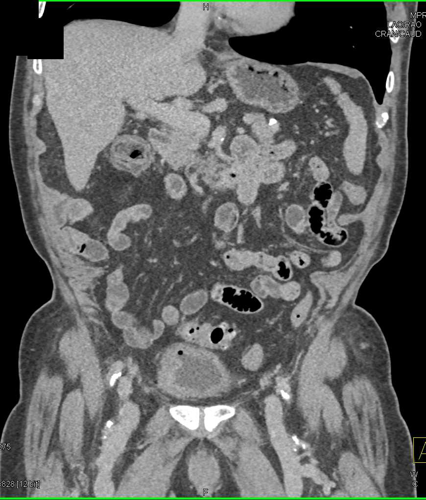 Diverticular Disease - CTisus CT Scan