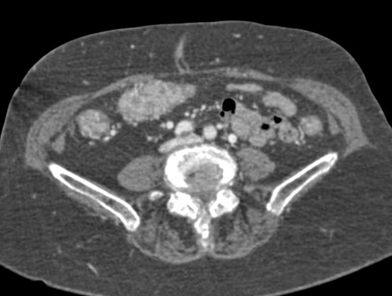 Inflammatory Colitis - CTisus CT Scan