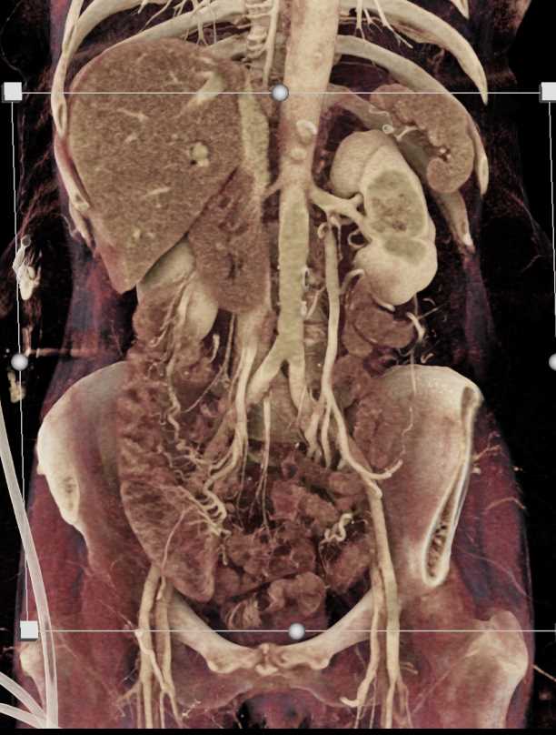 Inflammatory Colitis - CTisus CT Scan