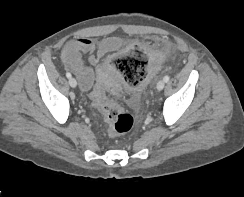 Sigmoid Colon Cancer with Abscess - CTisus CT Scan