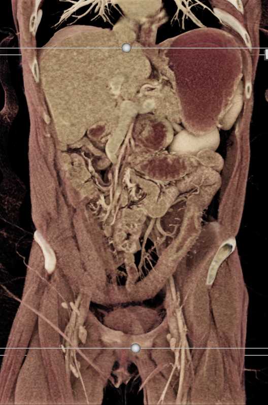 Colitis Involves the Descending Colon - CTisus CT Scan