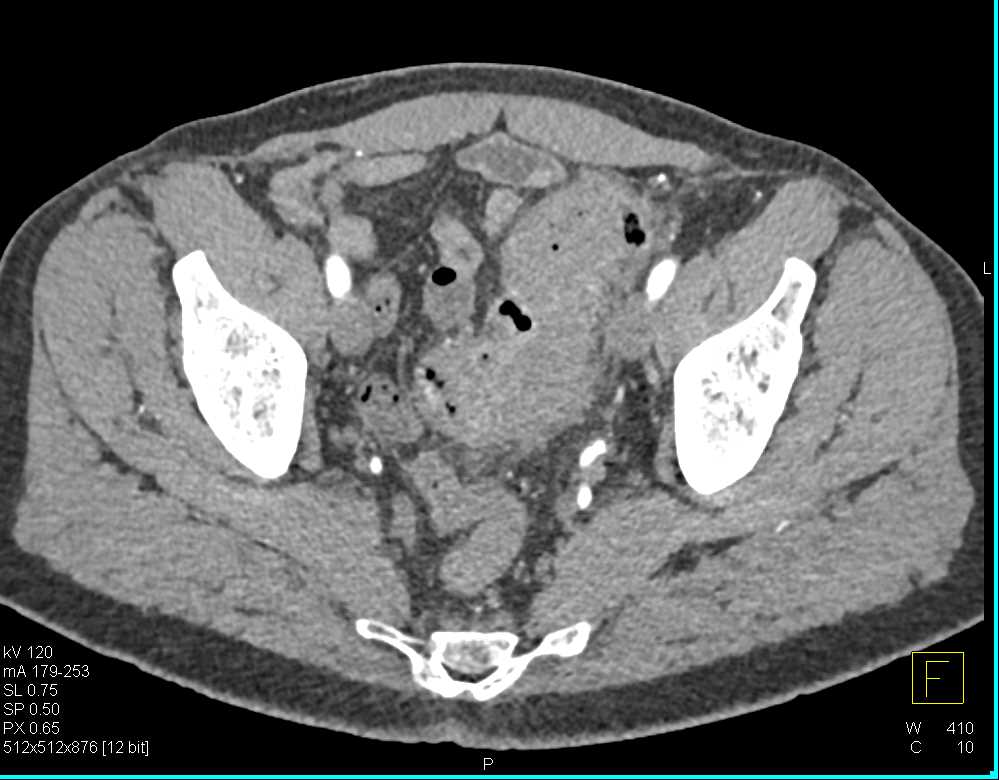 Carcinoma Sigmoid Colon - CTisus CT Scan