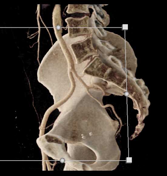 Carcinoma Sigmoid Colon - CTisus CT Scan