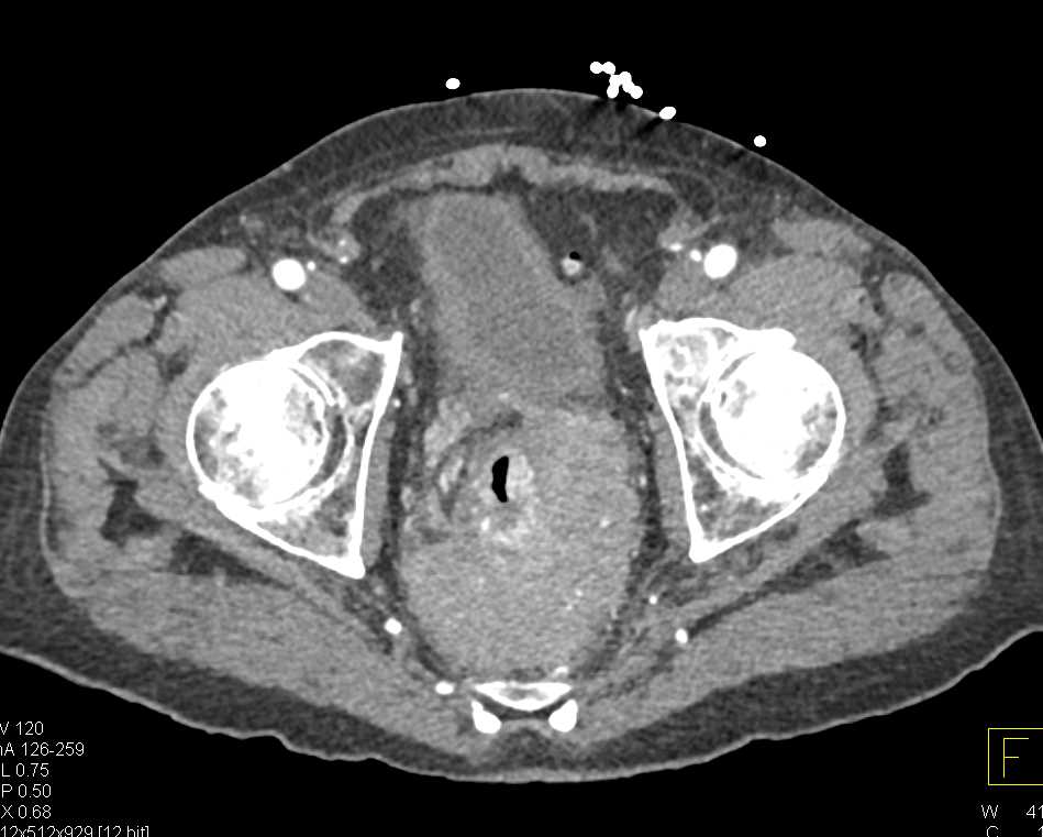 Lymphoma Encasees the Rectum - CTisus CT Scan