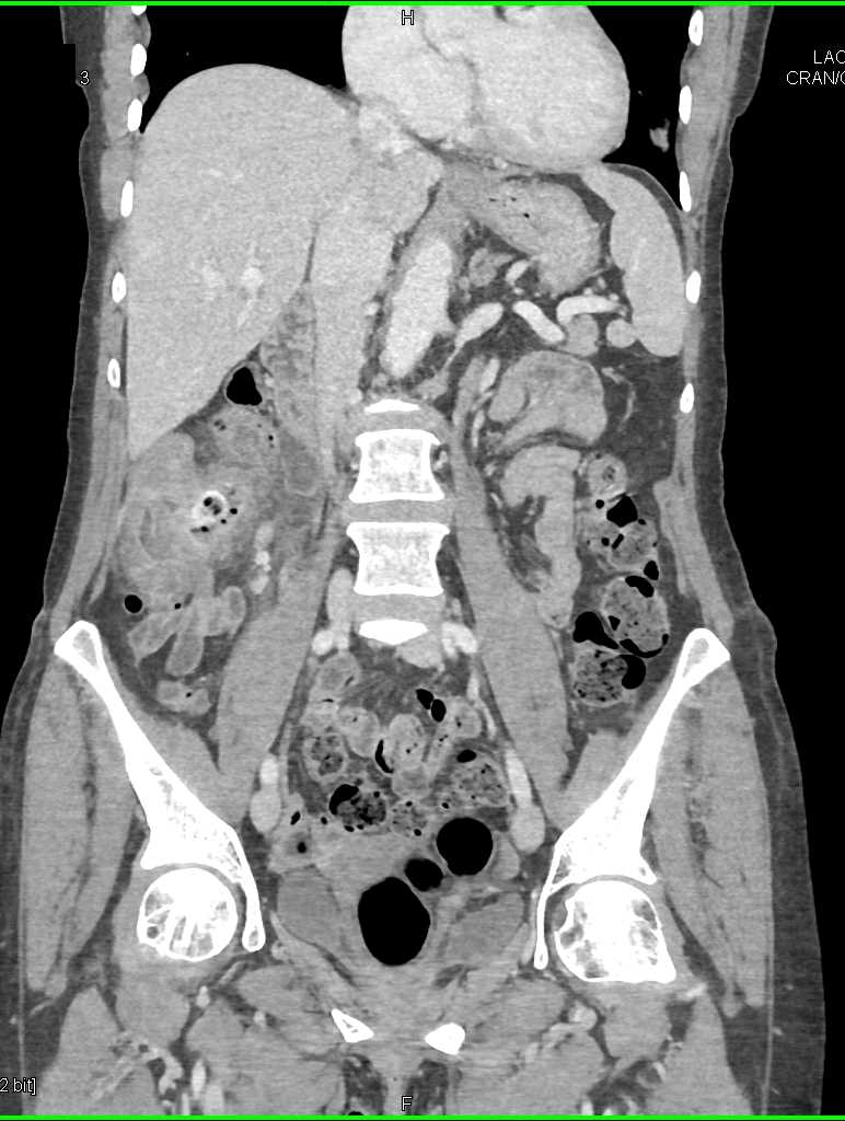 Right Sided Diverticulitis - CTisus CT Scan