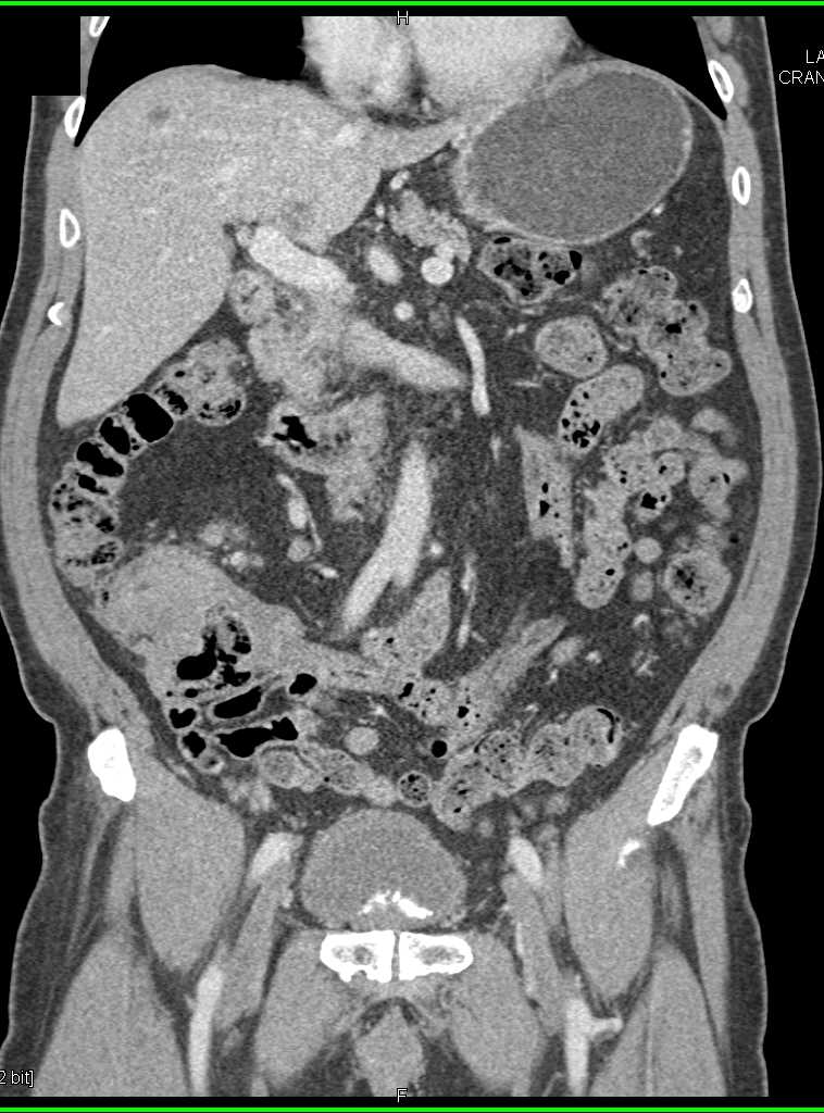 Cecal Carcinoma with Liver Metastases - CTisus CT Scan