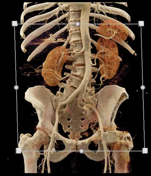 Infectious Colitis Descending Colon - CTisus CT Scan